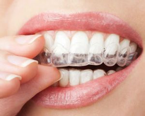 photo-of-teeth-whitening-trays