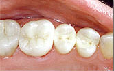 photo-of-mercury-free-dentist-white-filling-after